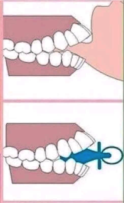 usar chupete o mamadera